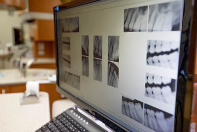 closeup of a computer screen showing a patients dental x-rays